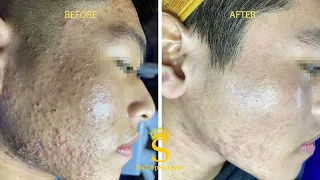 Acne Treatment For "Hung" (P20) | Điều Trị Mụn Cho Hùng (P20) - SacDepSpa#231