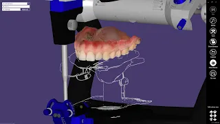 3D сканнер Medit i500 + Artex Facebow // Exocad