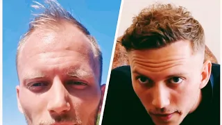 1 Year Hair Transplant Timeline - Day 0 to 365