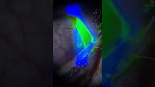 Removing a Torn Contact Lens