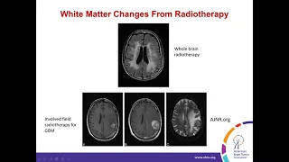 Long-Term Side Effects of Brain Tumor Treatment