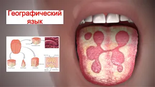 Географический Язык (Доброкачественный Мигрирующий Глоссит)