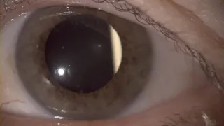 Ozurdex implant in the anterior vitreous