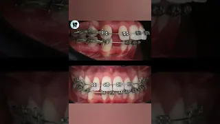 orthodontic treatment | before and after | time-lapse | your dentist | dando estetica #shorts #short