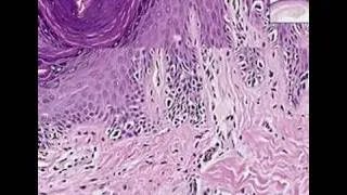 Histopathology Skin--Melanoma in situ