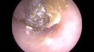 248  - Deep Impacted & Occluding Ear Wax Removal from Eardrum