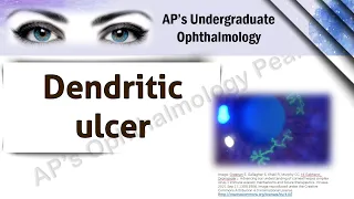 Dendritic ulcer | AP'S Undergraduate Ophthalmology