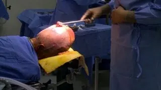 Indian surgeons reconstruct baby's swollen head