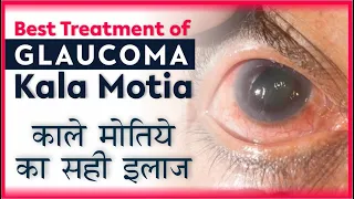 Latest Medical Treatment for Glaucoma patients | kala Motia Ka sahih ilaaj | काले मोतिये का सही इलाज