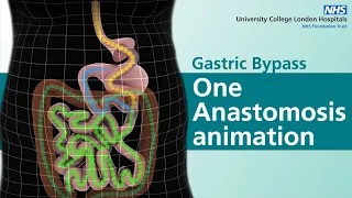 Gastric Bypass | One Anastomosis animation