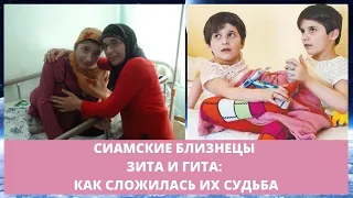 Сиамские близнецы Зита и Гита: как сложилась их судьба