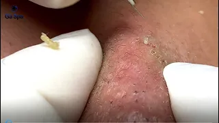 If You Like Squeezing Acnes, You'll Must be See This Video | Full 33 Minutes | GaSpa 18.03.2022