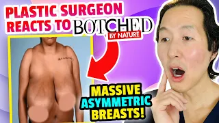 Plastic Surgeon Reacts to BOTCHED BY NATURE: HUGE, Droopy Breasts!