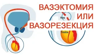 Вазэктомия или вазорезекция / Доктор Черепанов