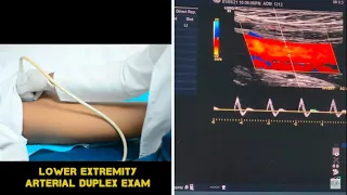 Lower Extremity Arterial Duplex Exam