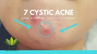 7 Cystic Acne Natural Remedies that Really Work