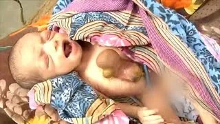 Girl Survives Being Born With Heart Beating Outside Chest