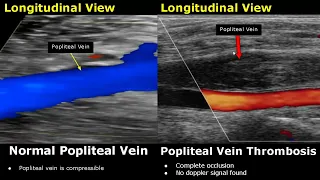 Popliteal Vein Doppler Ultrasound Normal Vs Abnormal Image Appearances | Deep Vein Thrombosis USG