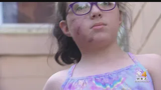 8-Year-Old Girl Attacked By Pit Bull In Her Own Yard; Police Looking For Dog Owner