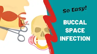 Buccal Space Infection | Dental Lectures