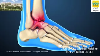Ankle Replacement (Hindi) - CIMS Hospital