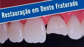 Restauração em Dente Fraturado