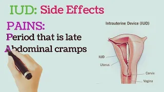 Intrauterine Device (IUD) Side Effects