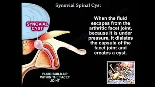 Synovial Cyst Of The Spine - Everything You Need To Know - Dr. Nabil Ebraheim