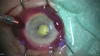 Vitrectomy of endophthalmitis when TAP and INJECT is not enough