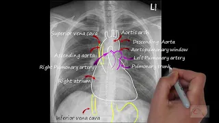 Chest x-ray  Normal  --  Chest x-ray  interpretation, normal anatomy on  a CXR