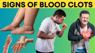 Top 8 Warning Signs of Blood Clots