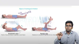 E6 Sample Video: Bacterial Meningitis (Paediatrics)