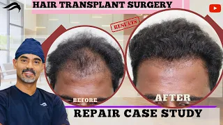 Hair Transplant In Bangalore | Best Surgeon Results Clinic & Cost Of Hair Transplant In Bangalore