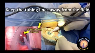 keep the tubing lines away during cataract surgery