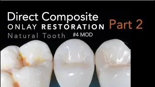 Direct Composite Onlay, Part 2: Restoration - #4 MOD Natural Tooth