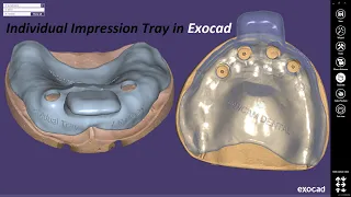 Individual Impression Tray design in Exocad / дизайн индивидуальной ложки