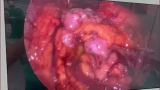 Videolaparoscopia para investigação de carcinomatose peritoneal