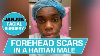 FOREHEAD SCARS IN A HAITIAN MALE - DR. TANVEER JANJUA - NEW JERSEY