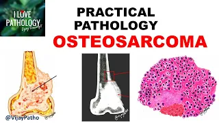 OSTEOSARCOMA: Clinical , Radiological features & Morphology