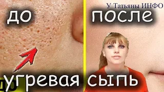 ИЗБАВЬТЕСЬ от ПРЫЩЕЙ и УГРЕВОЙ СЫПИ всего ЗА несколько ДНЕЙ!!!