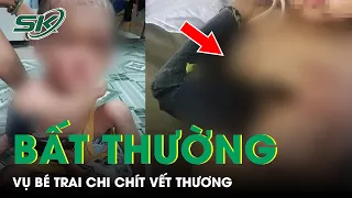 Phát Hiện Bất Thường Vụ Bé Trai Ở Hóc Môn Chi Chít Vết Thương, Công An Vào Cuộc Điều Tra | SKĐS