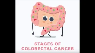 5 Stages of Colorectal Cancer Explained | Parkway Cancer Centre