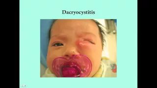 Dacryocystitis - CRASH! Medical Review Series