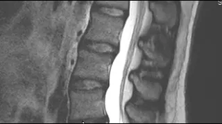 How to Read an MRI Scan of the Lumbar Spine | First Look MRI