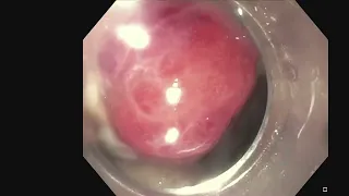 Endoscopic Management of Esophagogastric Anastomotic Disruption with Endoluminal Negative Pressu...