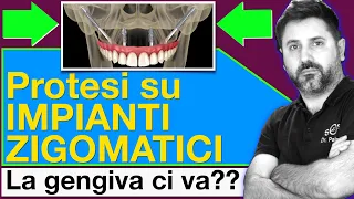 La Protesi su Impianti Zigomatici: Con o senza gengiva?