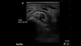 Thigh Ultrasound: Cellulitis of the Thigh (Short Axis, Part 2)