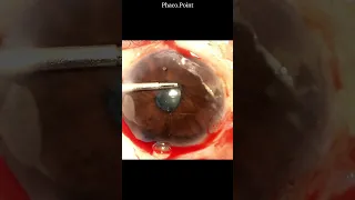 The technique of removing a fibrotic pupillary membrane in small pupil  phacoemulsification