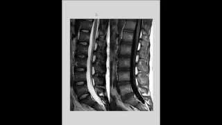 Videoaula e dicas em radiologia: T1 e T2 na ressonância magnética (RM) da Coluna vertebral.