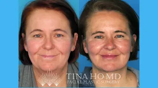 Patient Testimonial: Eyelid Lift + Facelift + Neck Lift